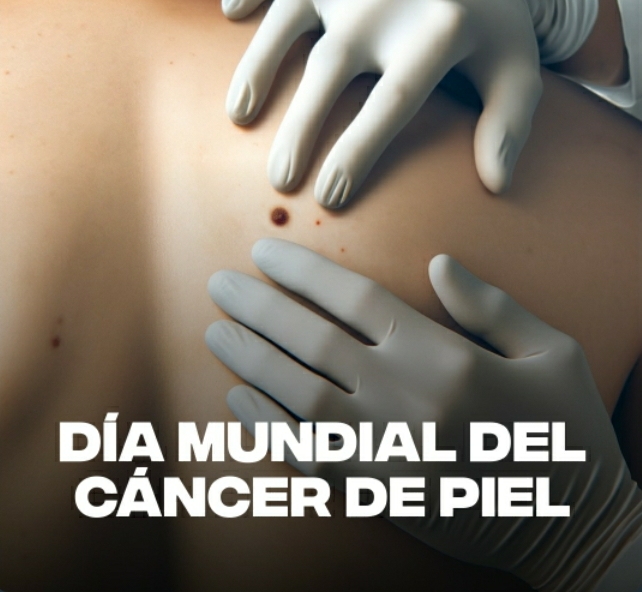 Día mundial del cáncer de piel: Síntomas y recomendaciones para tener en cuenta.