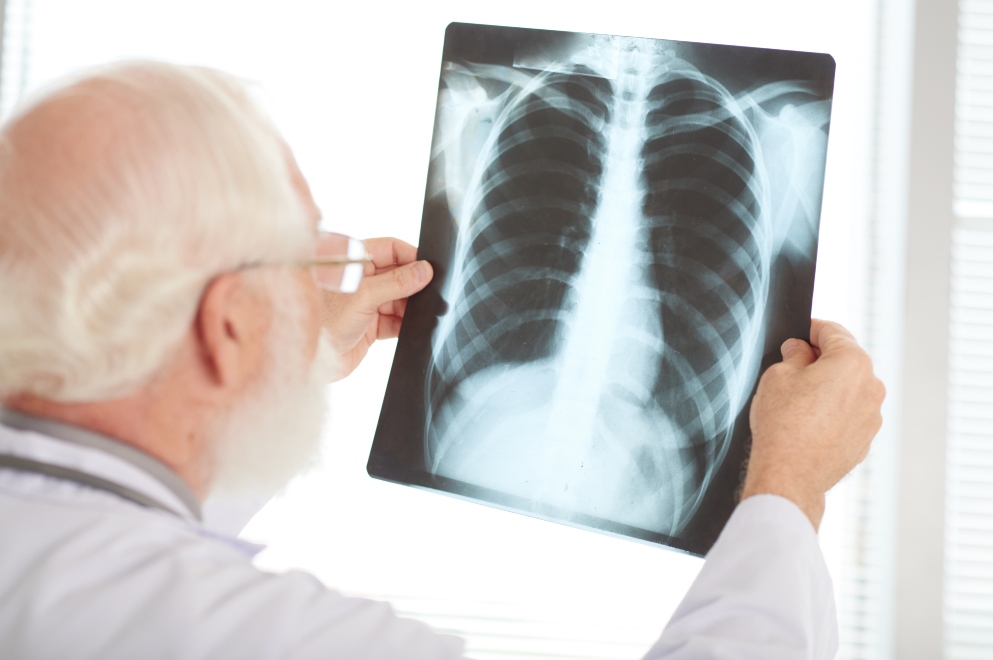 TUBERCULOSIS: CUÁLES SON SUS SÍNTOMAS Y CUÁNDO HACER UNA CONSULTA